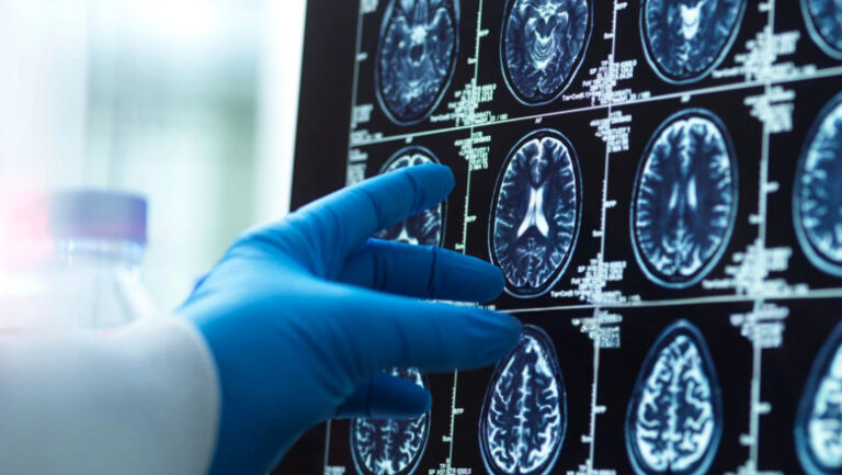 prima-harta-detaliata-a-imbatranirii-creierului:-de-ce-unele-zone-sunt-mai-vulnerabile-la-alzheimer